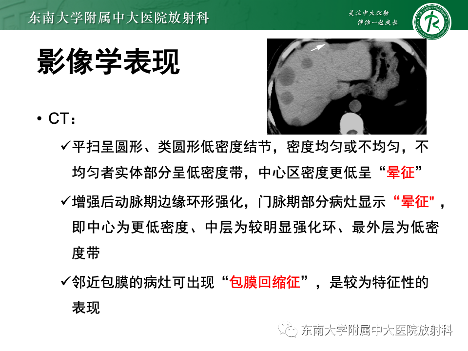 影像PPT - 【PPT】肝脏上皮样血管内皮瘤-9 影像PPT - 【PPT】肝脏上皮样血管内皮瘤-9
