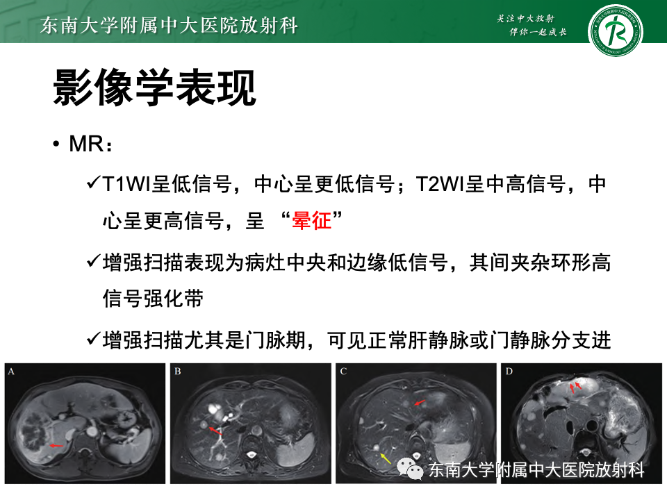 影像PPT - 【PPT】肝脏上皮样血管内皮瘤-10 影像PPT - 【PPT】肝脏上皮样血管内皮瘤-10