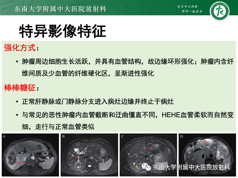 影像PPT - 【PPT】肝脏上皮样血管内皮瘤-11 影像PPT - 【PPT】肝脏上皮样血管内皮瘤-11