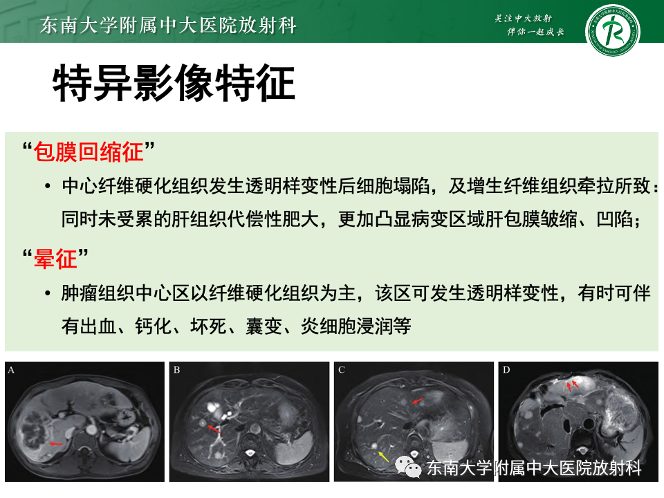 影像PPT - 【PPT】肝脏上皮样血管内皮瘤-12 影像PPT - 【PPT】肝脏上皮样血管内皮瘤-12