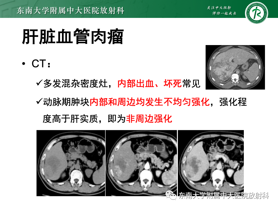 影像PPT - 【PPT】肝脏上皮样血管内皮瘤-15 影像PPT - 【PPT】肝脏上皮样血管内皮瘤-15