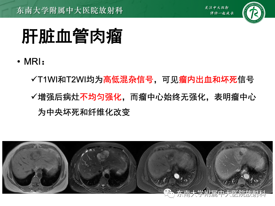 影像PPT - 【PPT】肝脏上皮样血管内皮瘤-16 影像PPT - 【PPT】肝脏上皮样血管内皮瘤-16