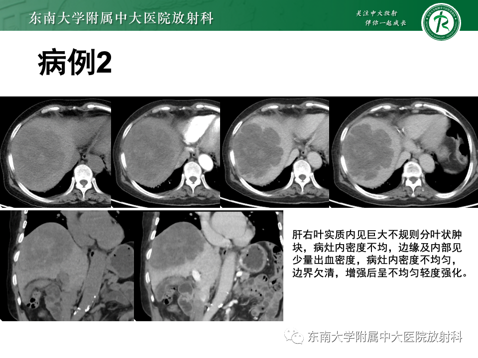 影像PPT - 【PPT】肝脏上皮样血管内皮瘤-18 影像PPT - 【PPT】肝脏上皮样血管内皮瘤-18