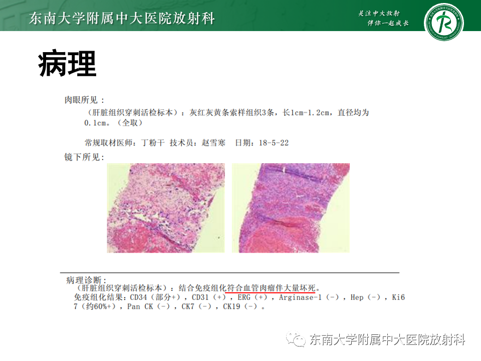 影像PPT - 【PPT】肝脏上皮样血管内皮瘤-19 影像PPT - 【PPT】肝脏上皮样血管内皮瘤-19