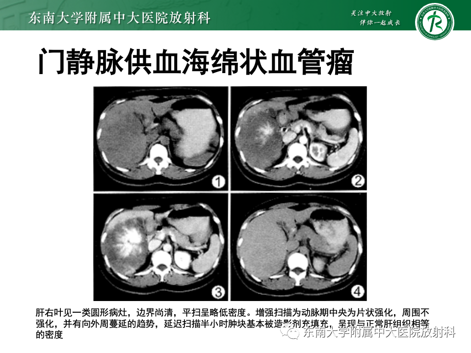 影像PPT - 【PPT】肝脏上皮样血管内皮瘤-21 影像PPT - 【PPT】肝脏上皮样血管内皮瘤-21