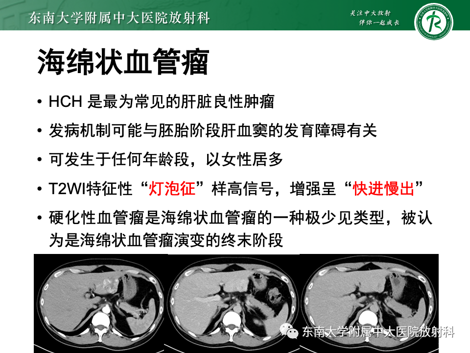 影像PPT - 【PPT】肝脏上皮样血管内皮瘤-20 影像PPT - 【PPT】肝脏上皮样血管内皮瘤-20
