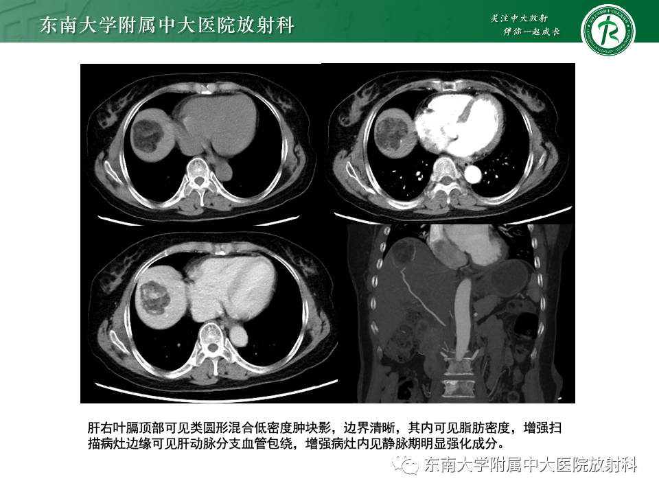 影像PPT - 【PPT】肝脏上皮样血管内皮瘤-25 影像PPT - 【PPT】肝脏上皮样血管内皮瘤-25