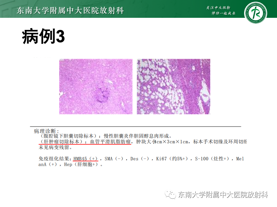 影像PPT - 【PPT】肝脏上皮样血管内皮瘤-26 影像PPT - 【PPT】肝脏上皮样血管内皮瘤-26