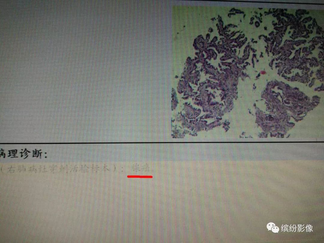 影像PPT - 【病例】肺黏液腺癌1例CT影像-5 影像PPT - 【病例】肺黏液腺癌1例CT影像-5