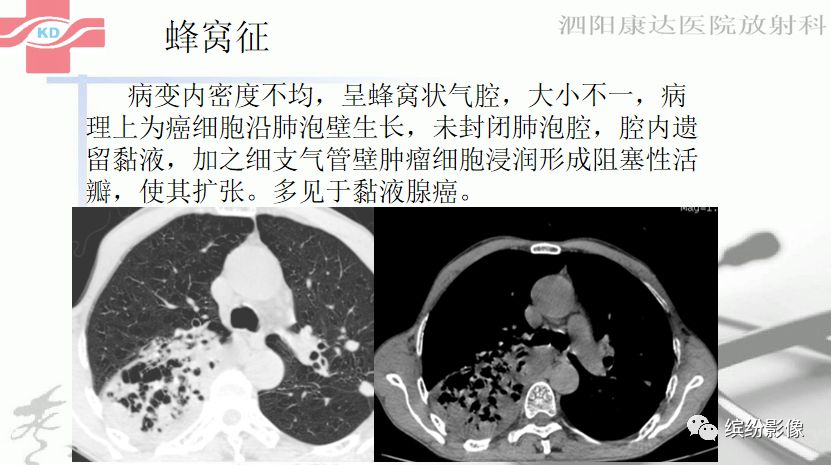 影像PPT - 【病例】肺黏液腺癌1例CT影像-7 影像PPT - 【病例】肺黏液腺癌1例CT影像-7