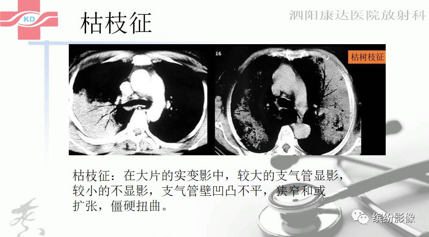 影像PPT - 【病例】肺黏液腺癌1例CT影像-6 影像PPT - 【病例】肺黏液腺癌1例CT影像-6