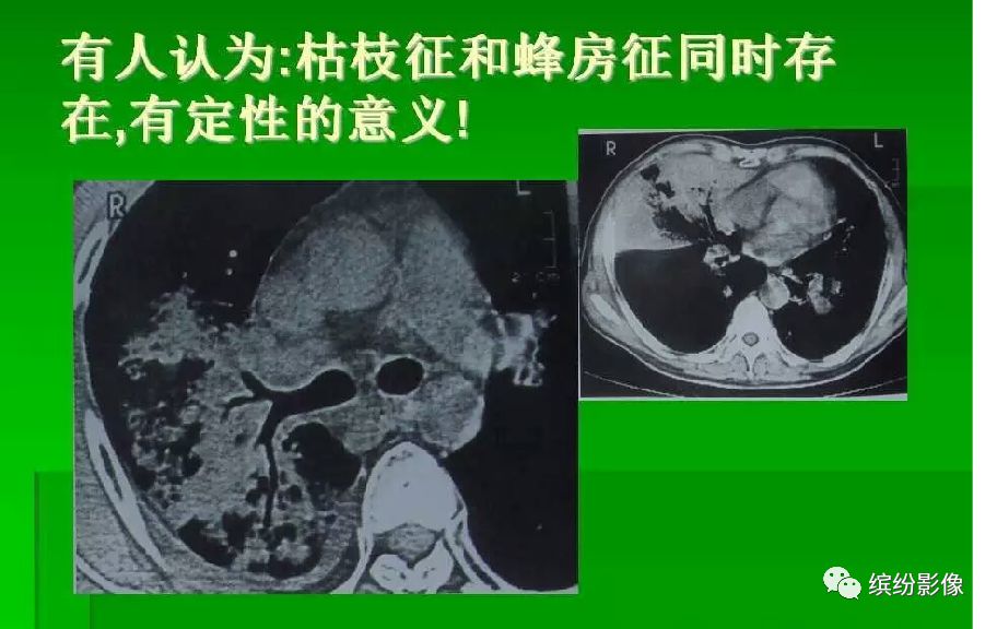 影像PPT - 【病例】肺黏液腺癌1例CT影像-8 影像PPT - 【病例】肺黏液腺癌1例CT影像-8