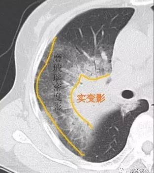 影像PPT - 【病例】肺黏液腺癌1例CT影像-10 影像PPT - 【病例】肺黏液腺癌1例CT影像-10