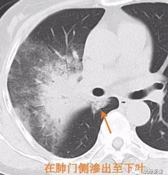 影像PPT - 【病例】肺黏液腺癌1例CT影像-9 影像PPT - 【病例】肺黏液腺癌1例CT影像-9