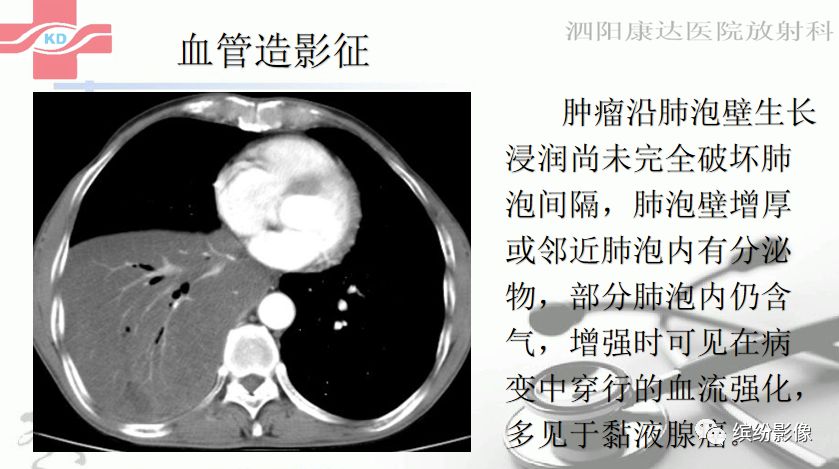 影像PPT - 【病例】肺黏液腺癌1例CT影像-13 影像PPT - 【病例】肺黏液腺癌1例CT影像-13