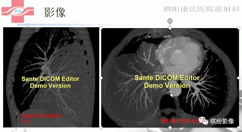 影像PPT - 【病例】肺黏液腺癌1例CT影像-15 影像PPT - 【病例】肺黏液腺癌1例CT影像-15