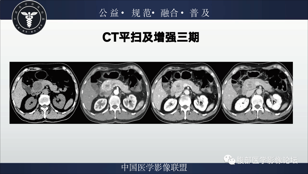 影像PPT - 【病例】胰腺浆液性囊腺瘤1例影像表现-3