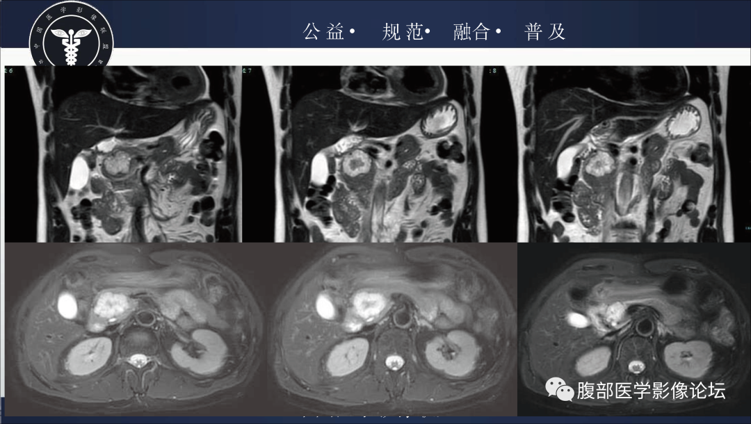 影像PPT - 【病例】胰腺浆液性囊腺瘤1例影像表现-5