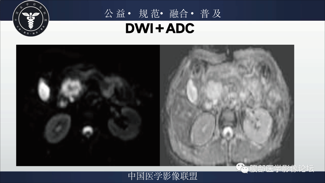 影像PPT - 【病例】胰腺浆液性囊腺瘤1例影像表现-6