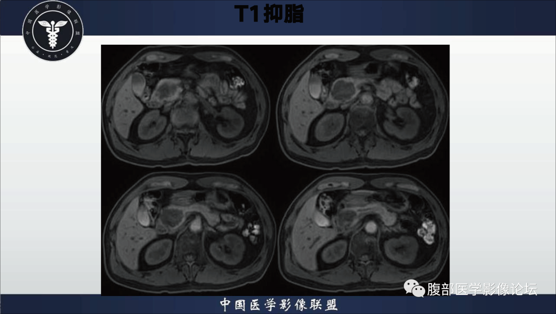 影像PPT - 【病例】胰腺浆液性囊腺瘤1例影像表现-7