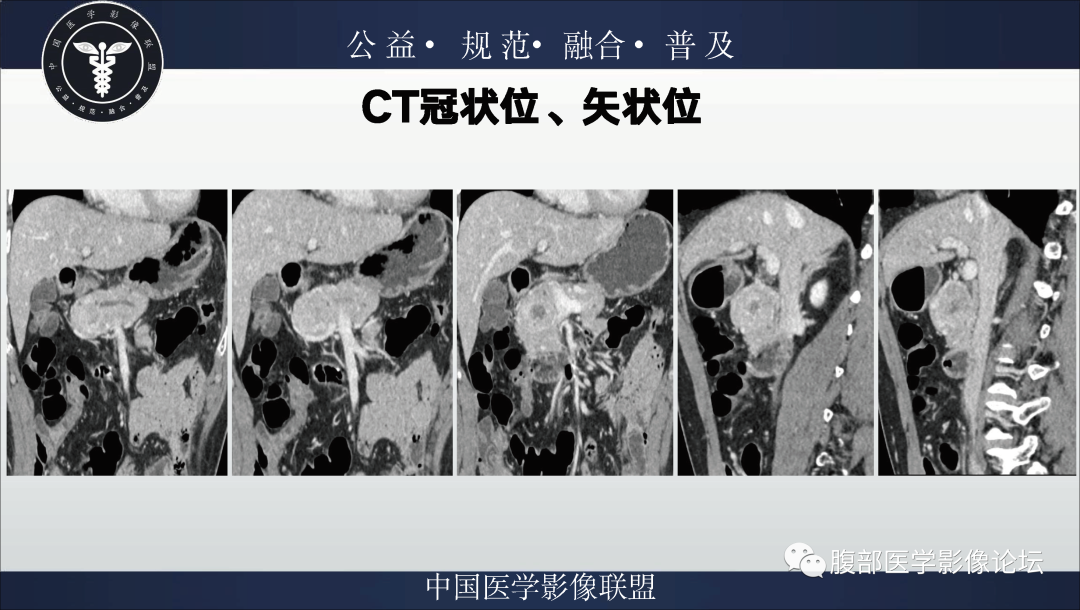 影像PPT - 【病例】胰腺浆液性囊腺瘤1例影像表现-4
