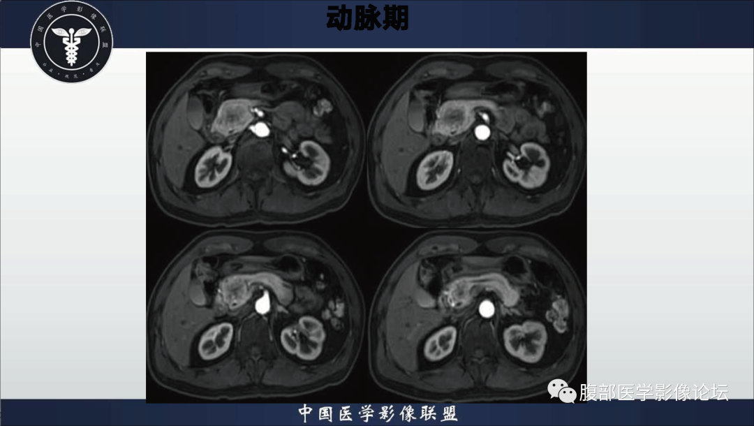 影像PPT - 【病例】胰腺浆液性囊腺瘤1例影像表现-8