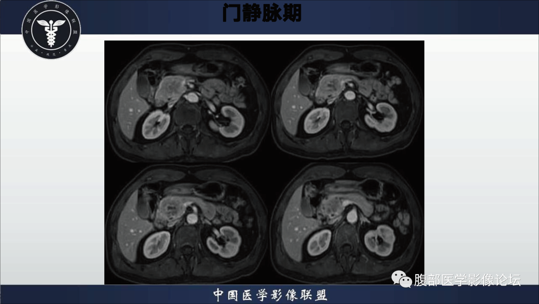 影像PPT - 【病例】胰腺浆液性囊腺瘤1例影像表现-9