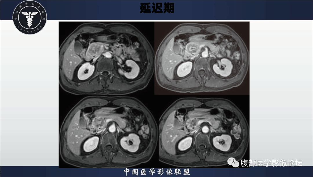 影像PPT - 【病例】胰腺浆液性囊腺瘤1例影像表现-10