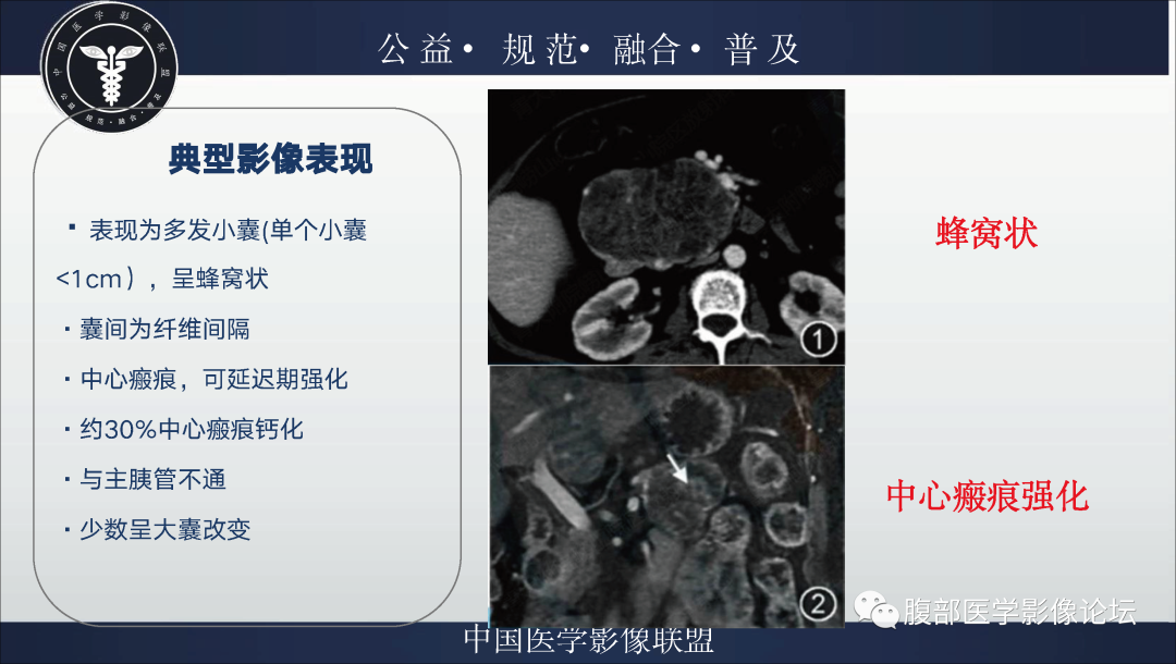 影像PPT - 【病例】胰腺浆液性囊腺瘤1例影像表现-16