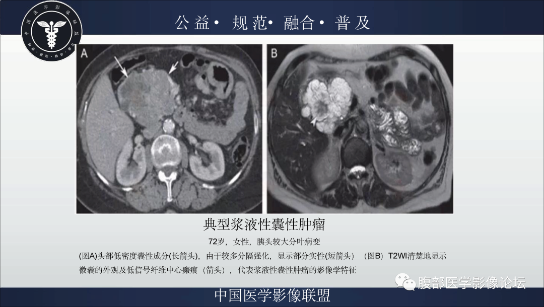 影像PPT - 【病例】胰腺浆液性囊腺瘤1例影像表现-17