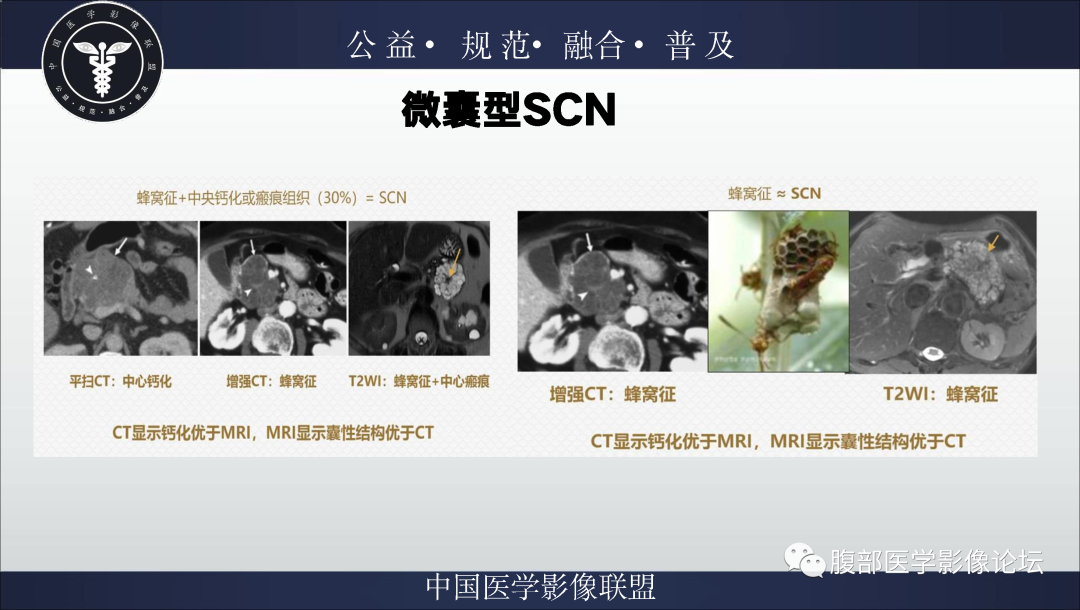 影像PPT - 【病例】胰腺浆液性囊腺瘤1例影像表现-18
