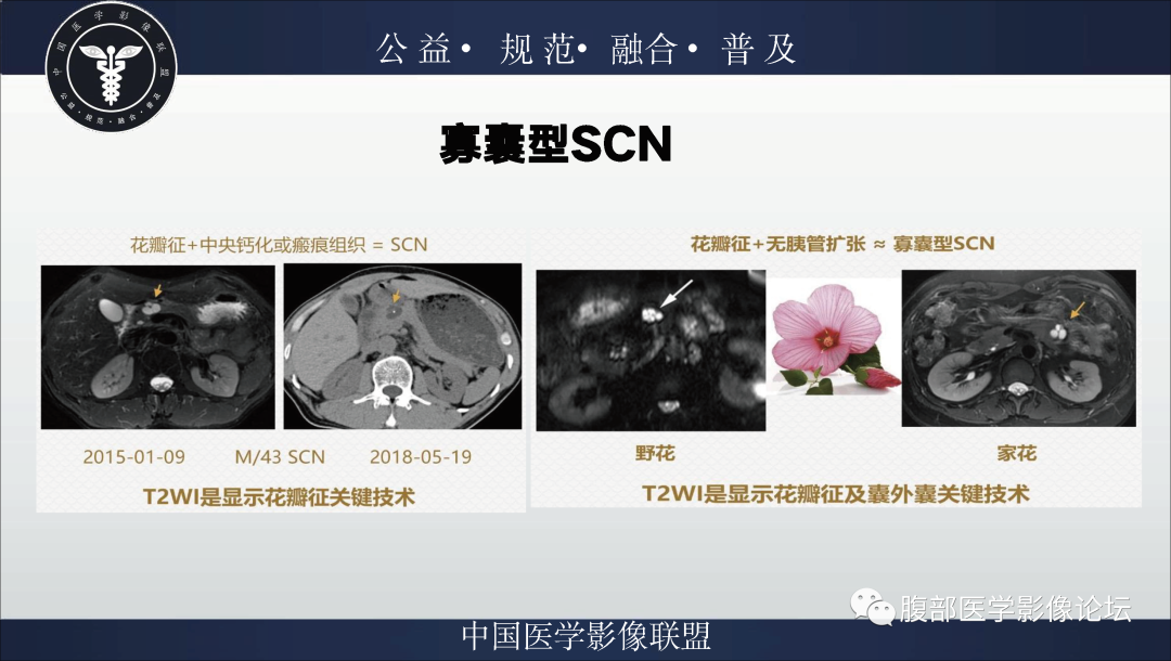 影像PPT - 【病例】胰腺浆液性囊腺瘤1例影像表现-19