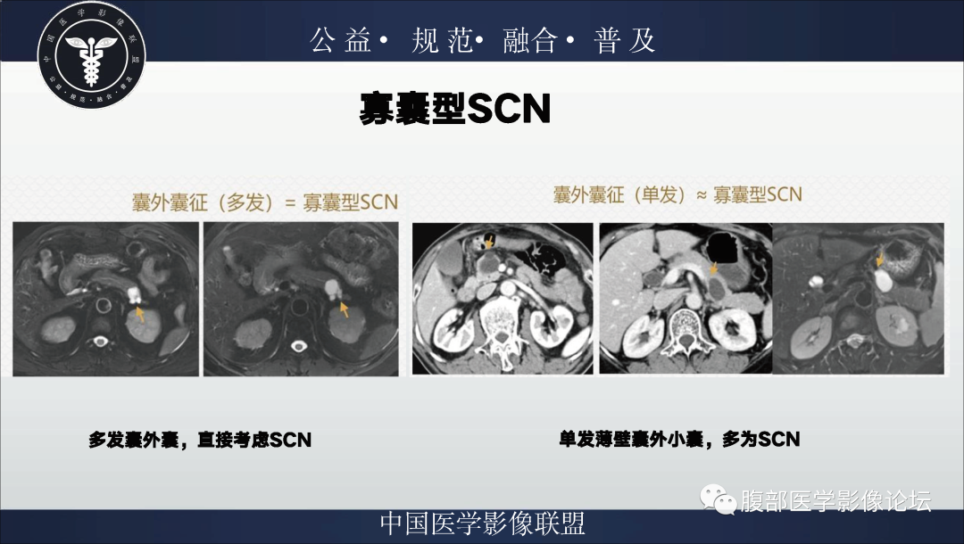 影像PPT - 【病例】胰腺浆液性囊腺瘤1例影像表现-20