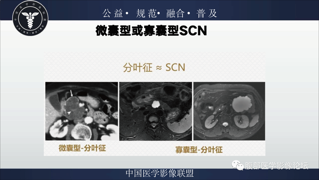 影像PPT - 【病例】胰腺浆液性囊腺瘤1例影像表现-21