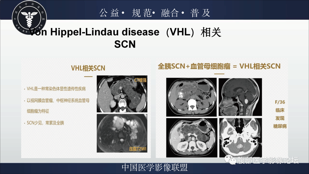 影像PPT - 【病例】胰腺浆液性囊腺瘤1例影像表现-23