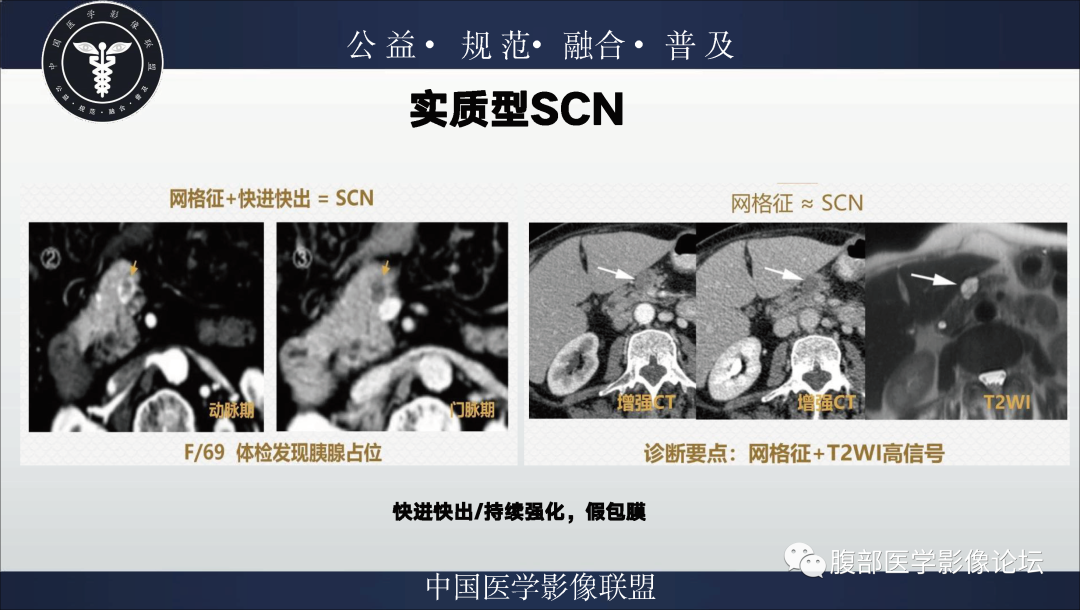 影像PPT - 【病例】胰腺浆液性囊腺瘤1例影像表现-22