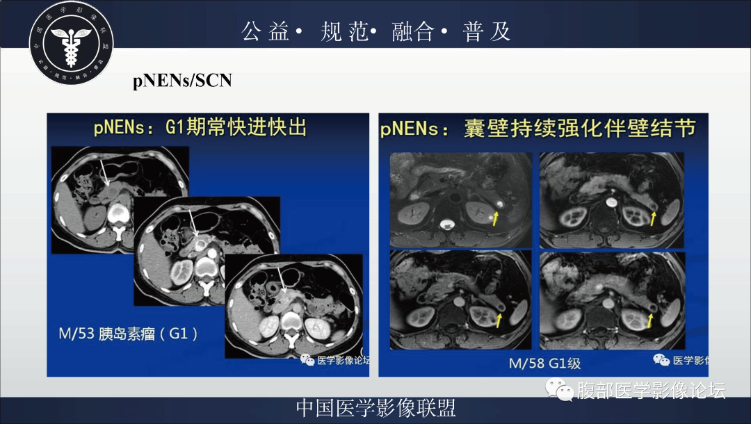 影像PPT - 【病例】胰腺浆液性囊腺瘤1例影像表现-26