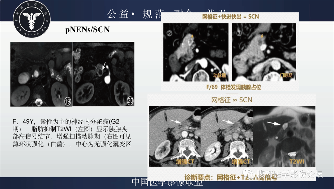 影像PPT - 【病例】胰腺浆液性囊腺瘤1例影像表现-27