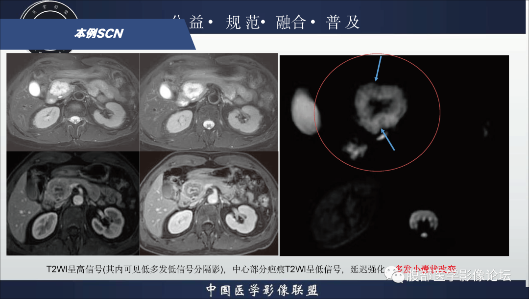 影像PPT - 【病例】胰腺浆液性囊腺瘤1例影像表现-28