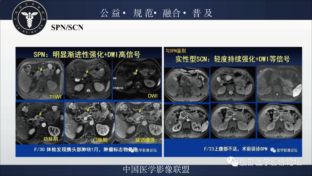 影像PPT - 【病例】胰腺浆液性囊腺瘤1例影像表现-30