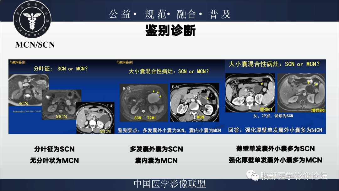 影像PPT - 【病例】胰腺浆液性囊腺瘤1例影像表现-32
