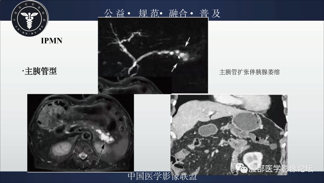 影像PPT - 【病例】胰腺浆液性囊腺瘤1例影像表现-34