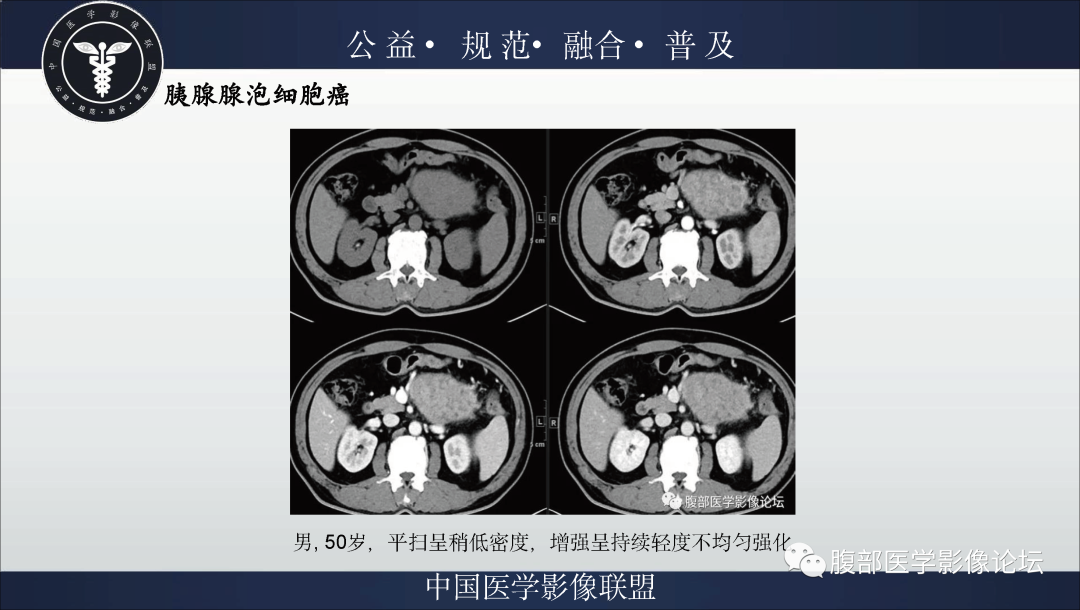 影像PPT - 【病例】胰腺浆液性囊腺瘤1例影像表现-37