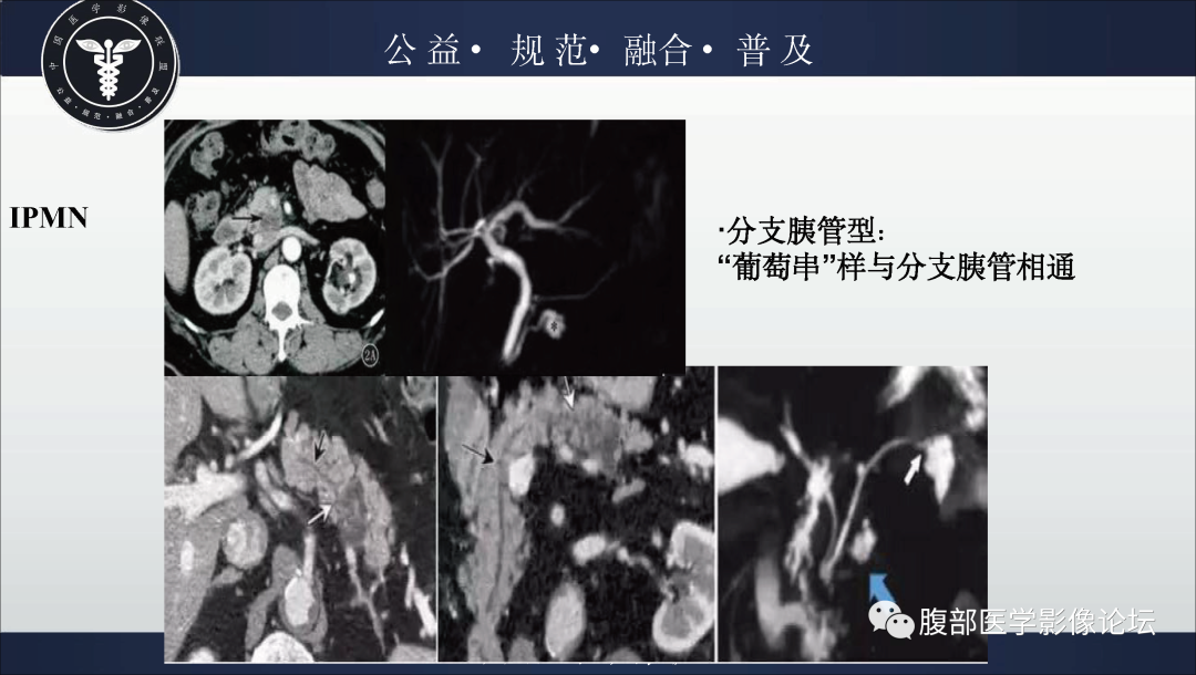 影像PPT - 【病例】胰腺浆液性囊腺瘤1例影像表现-35
