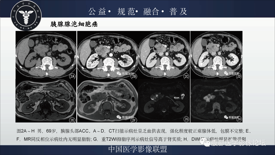影像PPT - 【病例】胰腺浆液性囊腺瘤1例影像表现-38