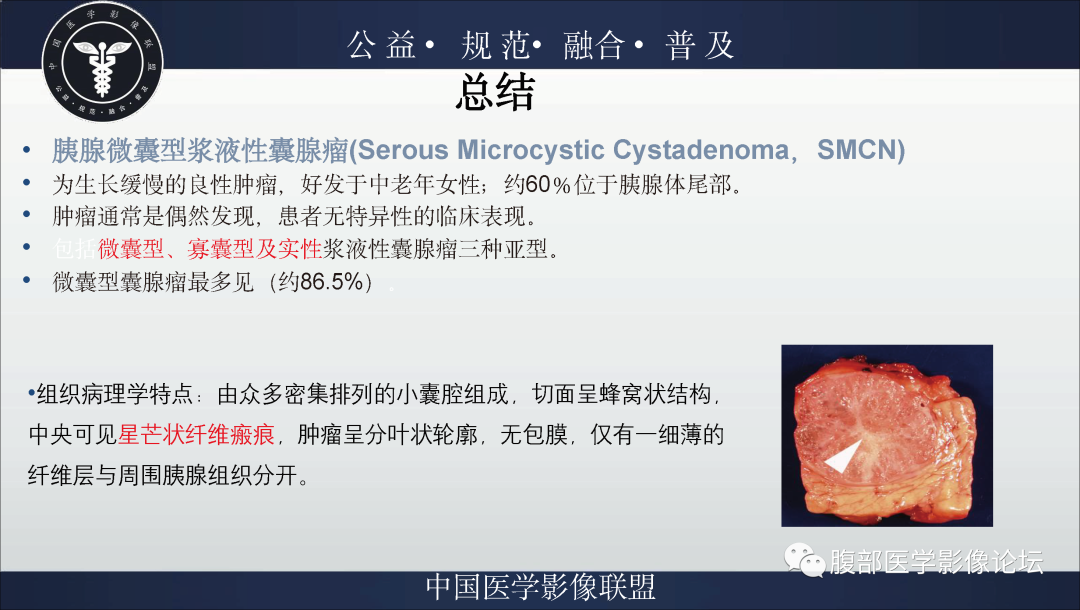影像PPT - 【病例】胰腺浆液性囊腺瘤1例影像表现-40