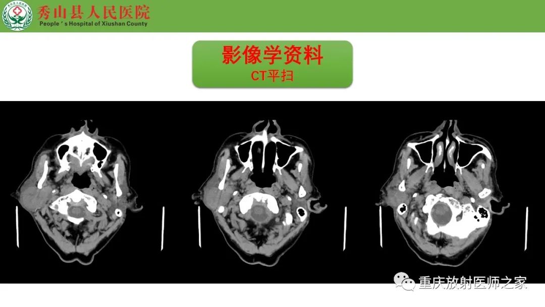 影像PPT - 【病例】腮腺基底细胞腺瘤1例CT影像-4
