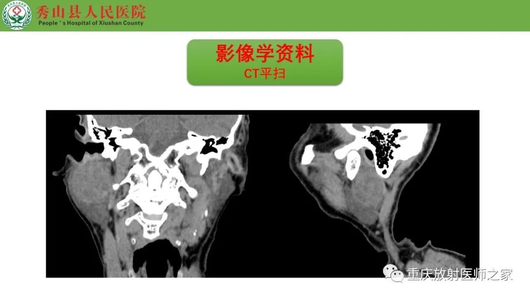 影像PPT - 【病例】腮腺基底细胞腺瘤1例CT影像-5