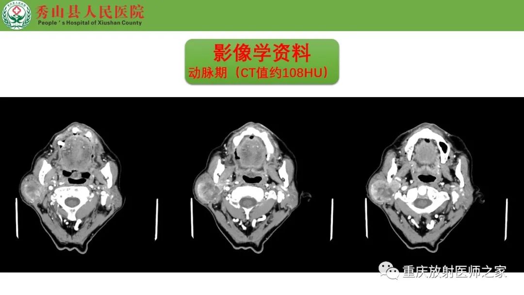 影像PPT - 【病例】腮腺基底细胞腺瘤1例CT影像-6