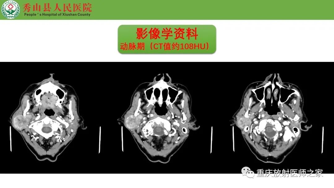 影像PPT - 【病例】腮腺基底细胞腺瘤1例CT影像-7